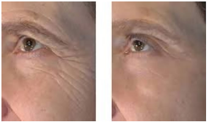 Microneedling