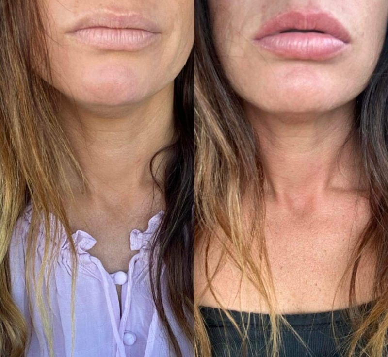 lips before and after